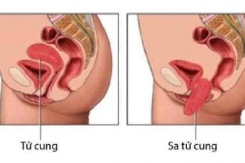 Hình ảnh sa tử cung